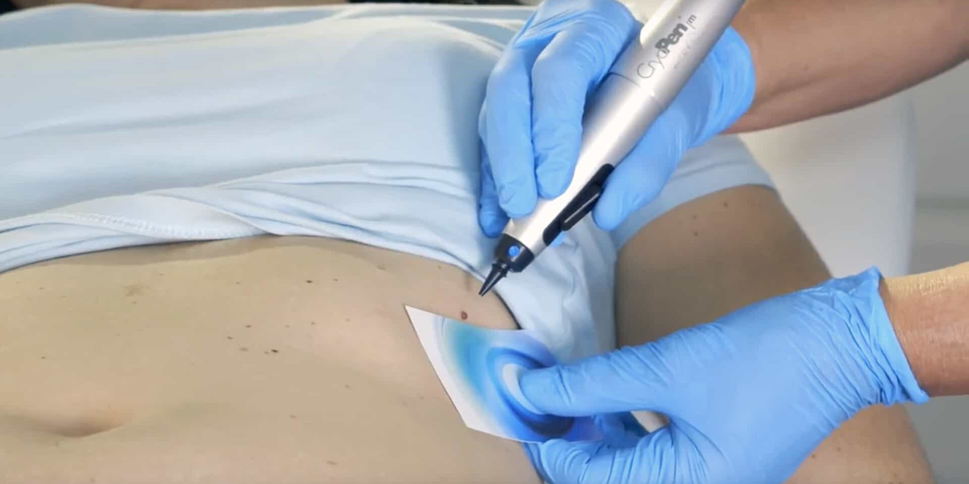 cryopen wart removal Tallaght