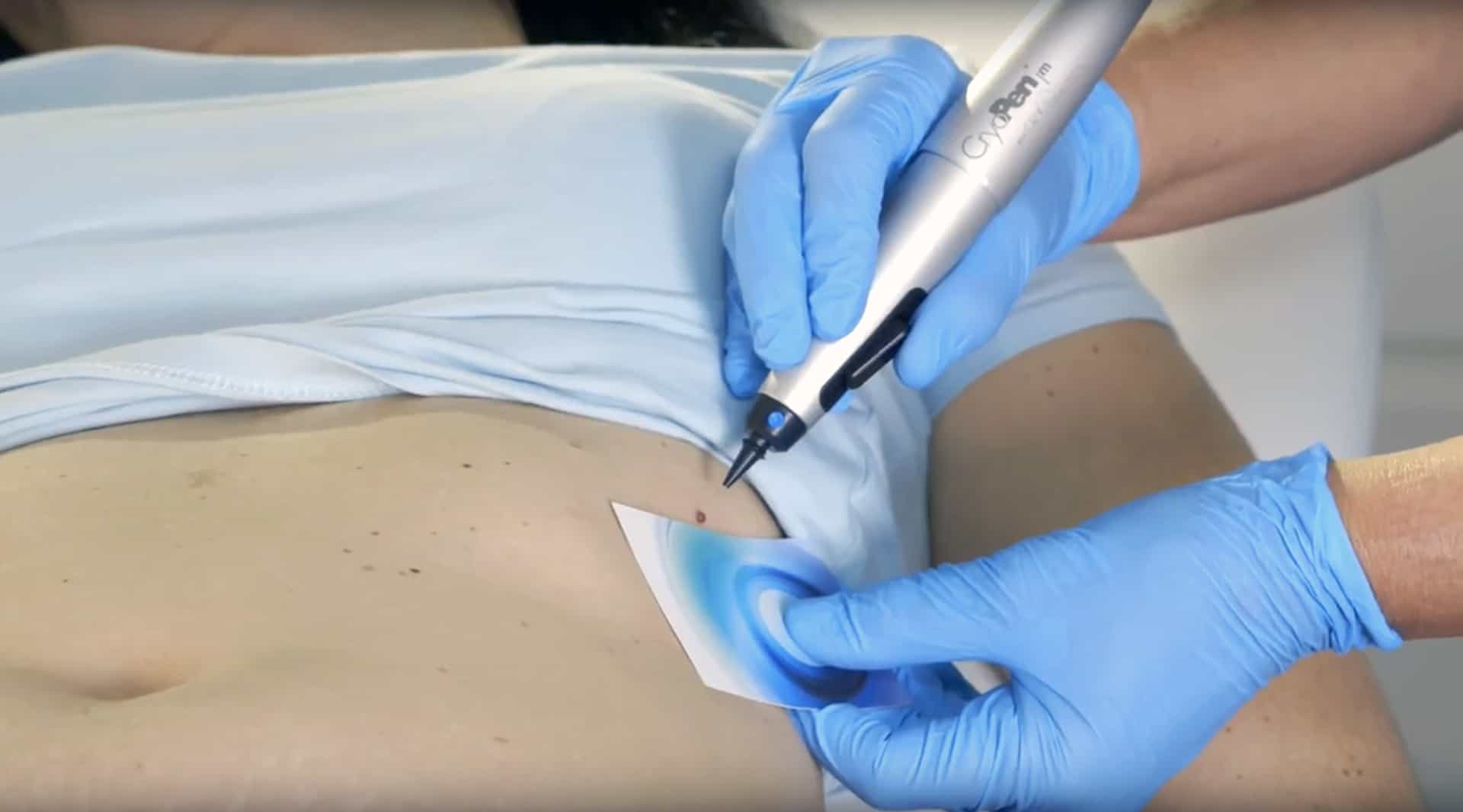 cryopen wart removal Tallaght